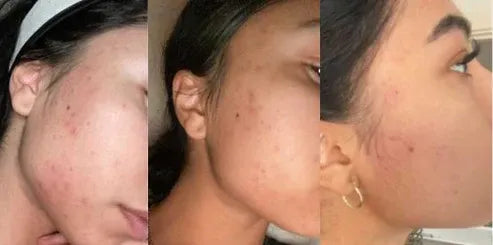 Aaponminimarket Argan Acne Rehab Serum 30ml