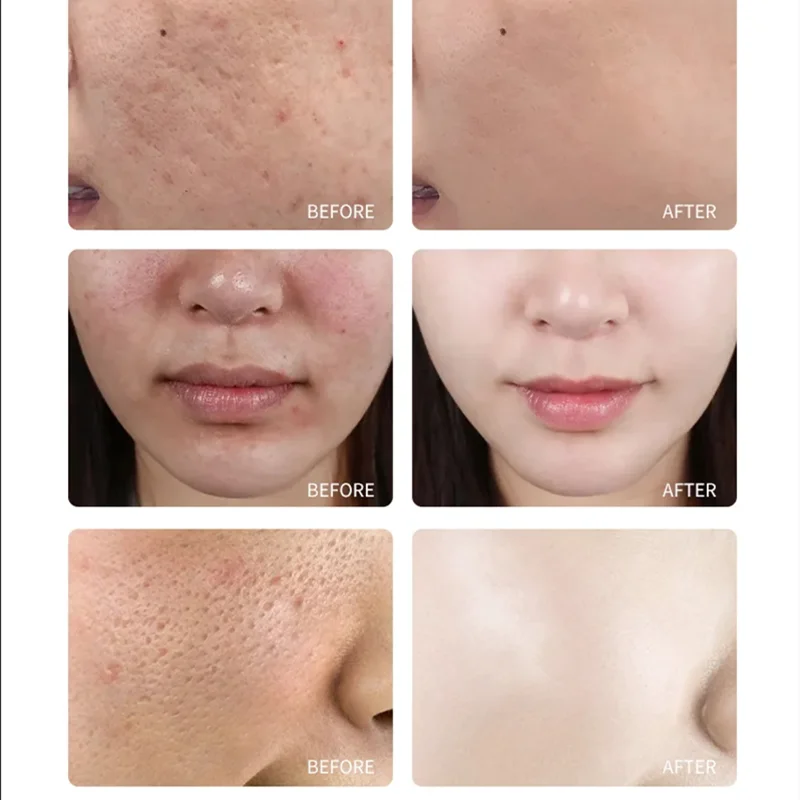 Aapon Mini Market Ltd TCA Skin Peel & Pore Minimizer