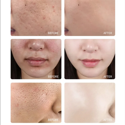 Aapon Mini Market Ltd TCA Skin Peel & Pore Minimizer