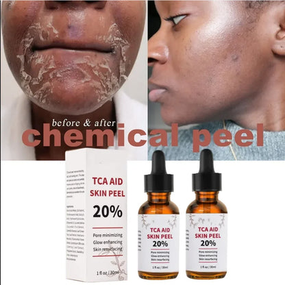 Aapon Mini Market Ltd TCA Skin Peel & Pore Minimizer