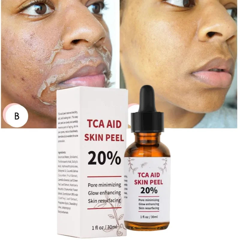Aapon Mini Market Ltd TCA Skin Peel & Pore Minimizer